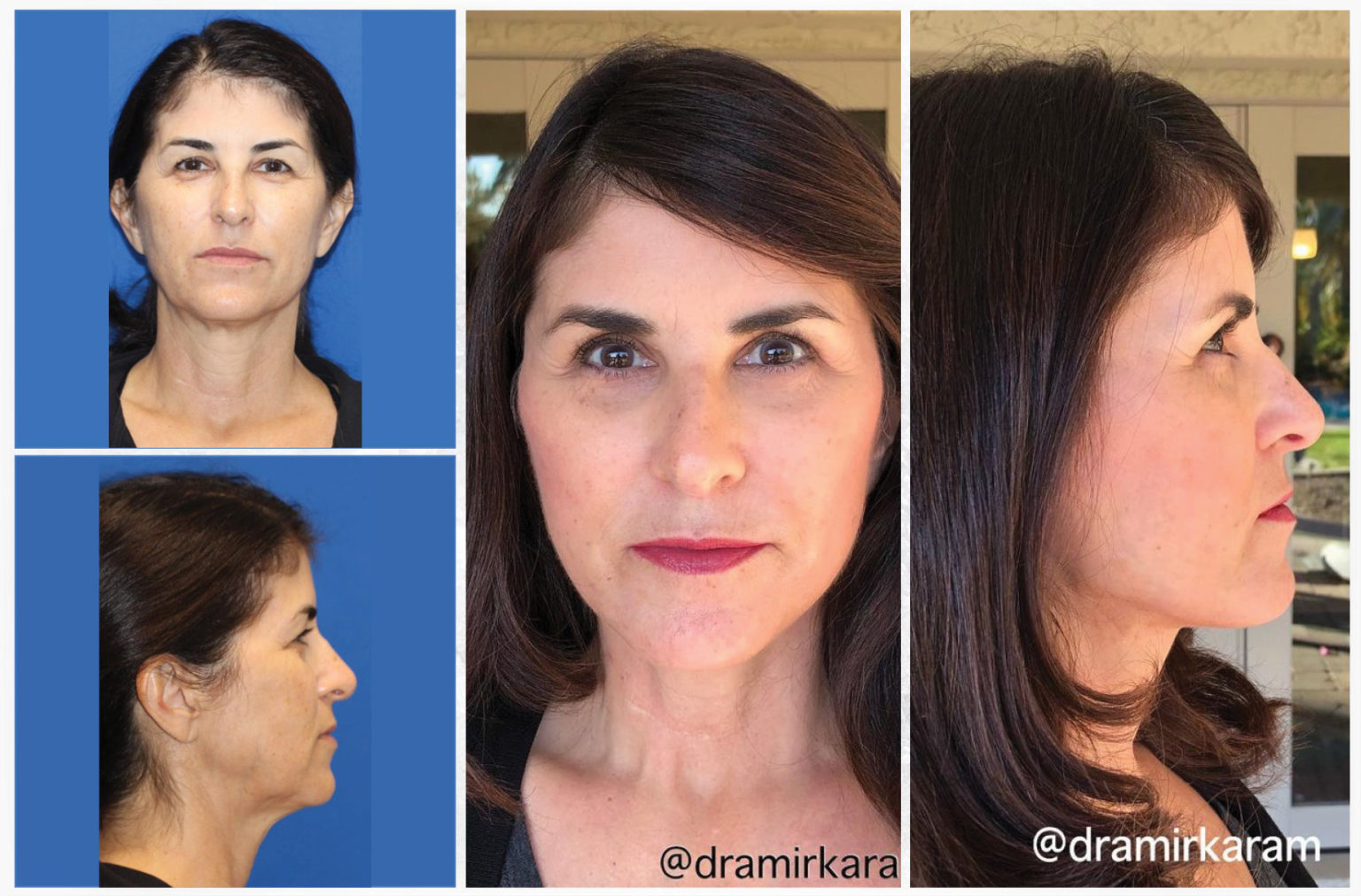 Is Vertical Restore 2021’s Most Promising Procedure? Alphabeautics